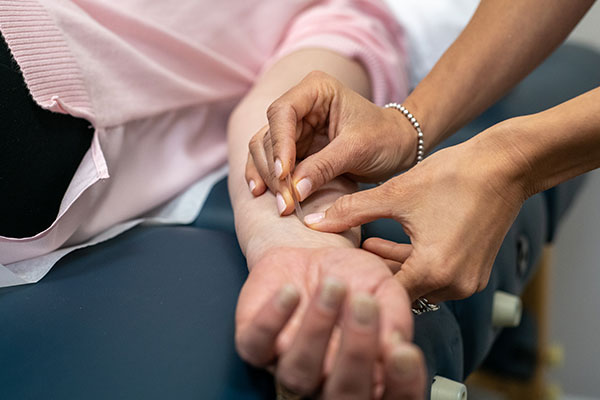 Acupuncture