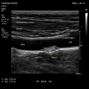 Carotid artery ultrasound showing plaque buildup within the carotid artery as part of a cardiovascular assessment.
