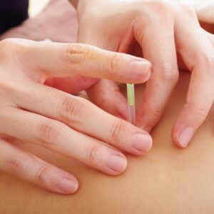 Naturopathic doctor providing acupuncture treatment to a patient at Hudson Integrative Healthcare
