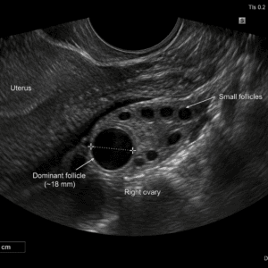 Pelvic ultrasound showing a normal ovary with a dominant follicle developing before ovulation.