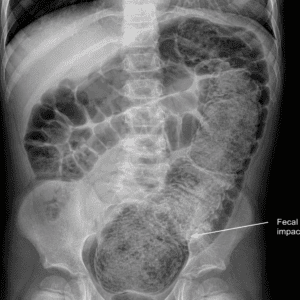 Abdominal X-ray illustrating significant stool retention and fecal impaction in the colon and rectum.