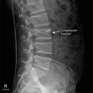 Lateral lumbar spine X-ray showing a vertebral compression fracture in the lower back.