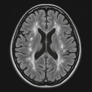 AI-generated MRI-style brain illustration with bright areas representing possible vascular changes.